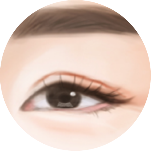 처진눈 교정 추천 시술 4