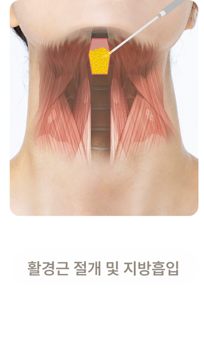 활경근 절개 및 지방흡입