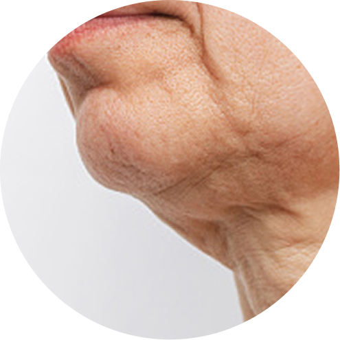 이중턱 추천 시술 1