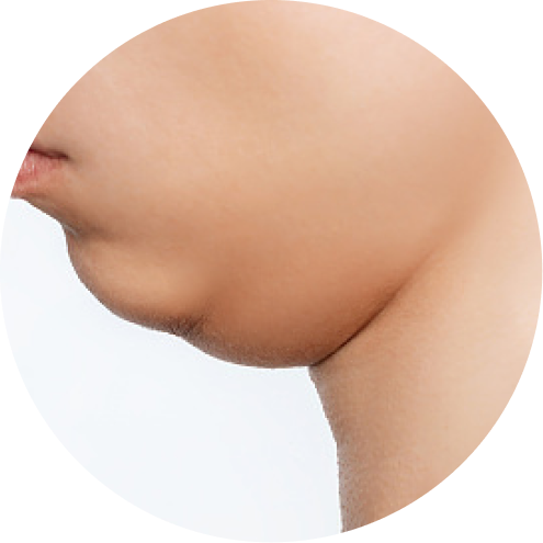 이중턱 추천 시술 2