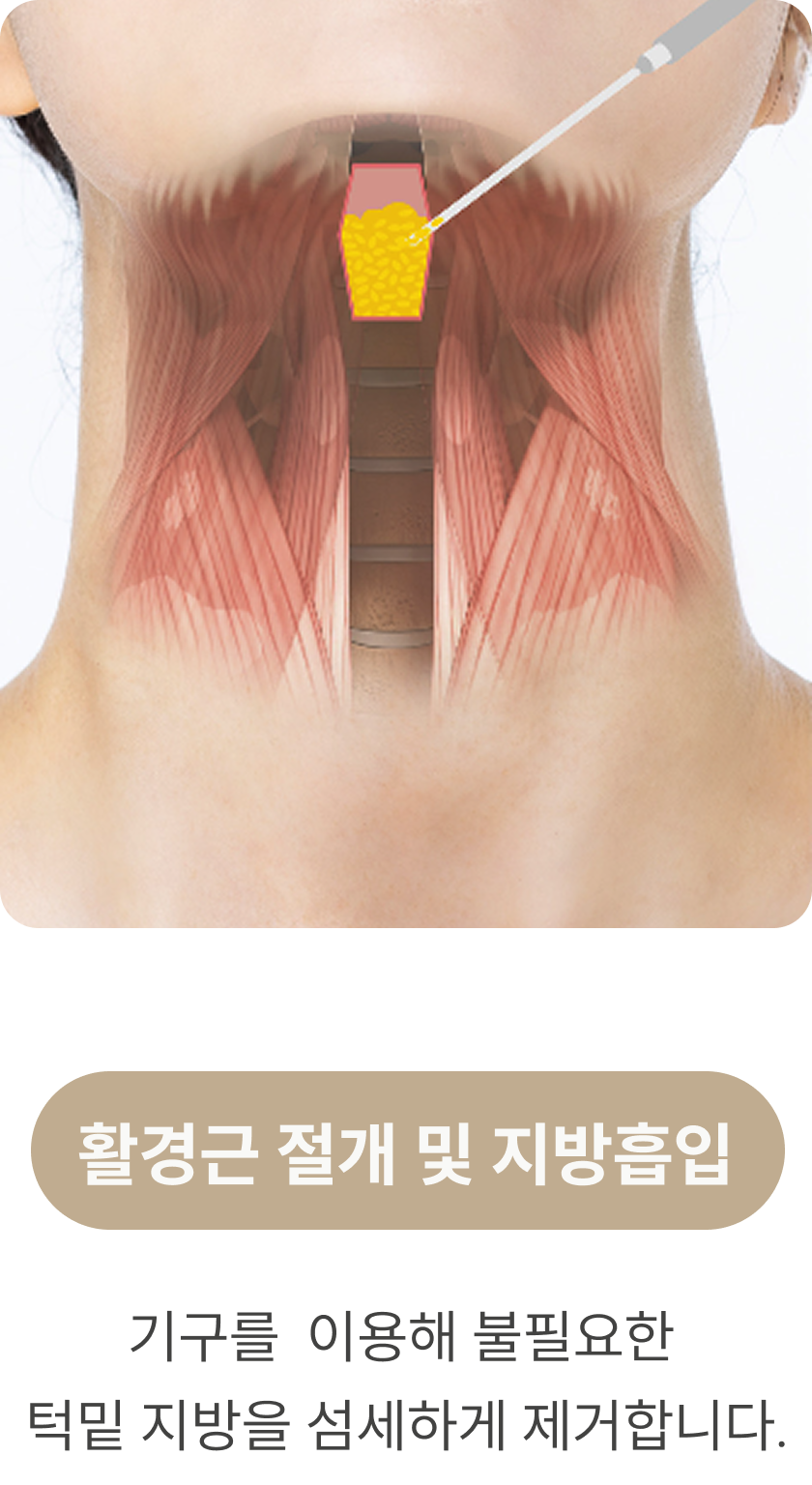 활경근 절개 및 지방흡입