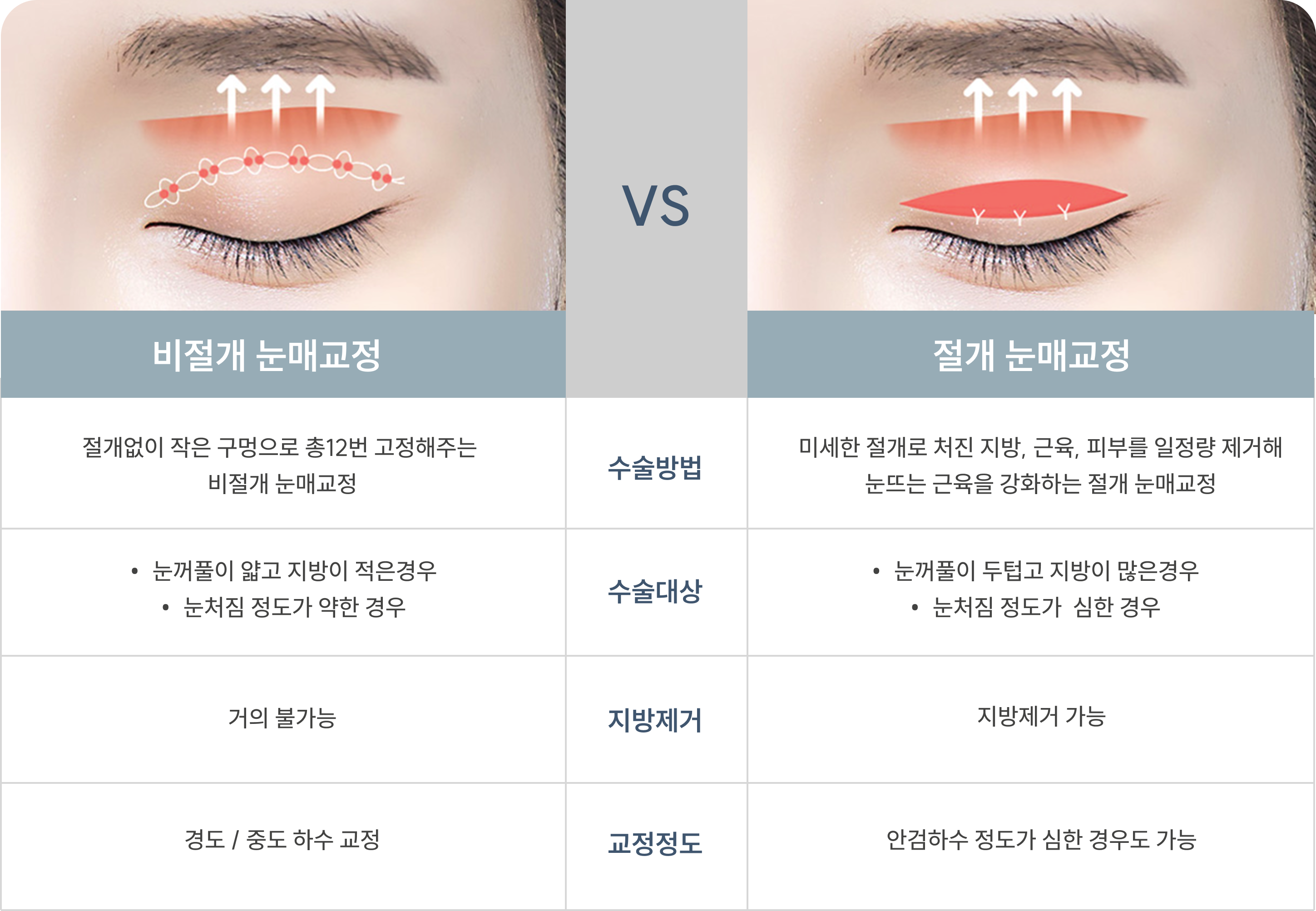 눈매교정 사례 1