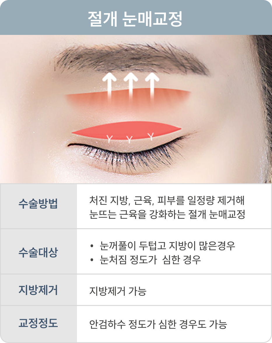 눈매교정 비교 2