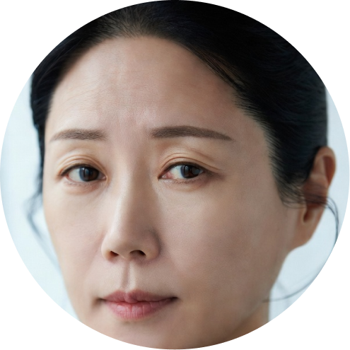 눈매교정 추천 시술 1