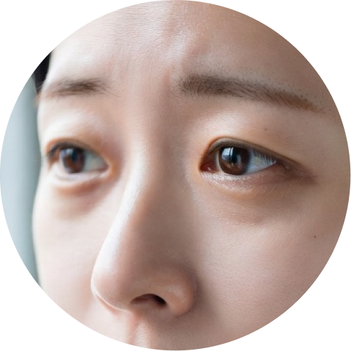 눈매교정 추천 시술 4