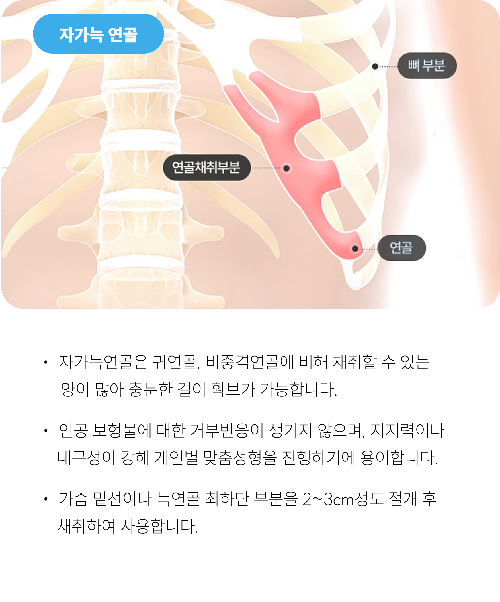 자가늑연골 / 기증늑연골 이미지