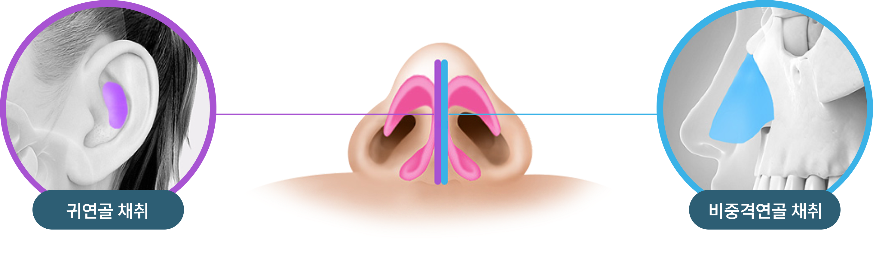 비중격 & 귀연골 복합체 코성형 이미지
