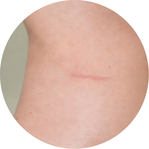 비중격 & 귀연골 코성형 추천 시술 2